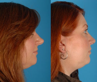 Rhinoplasty