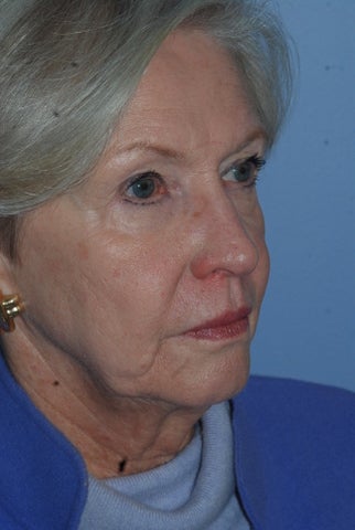 Sculptra treatment