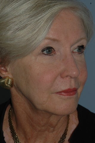 Sculptra treatment