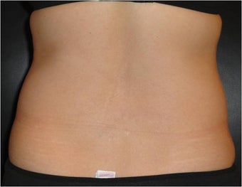 SmartLipo MPX with PRO-Sculpt