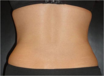 SmartLipo MPX with PRO-Sculpt