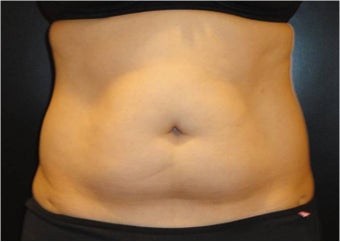 SmartLipo MPX with PRO-Sculpt