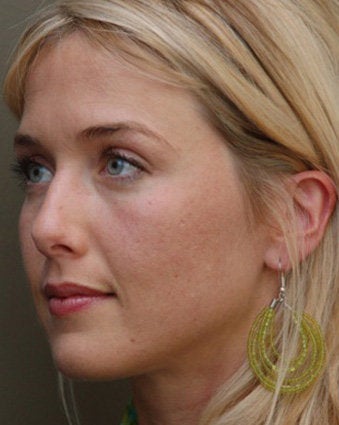 Cheek Augmentation Using Restylane