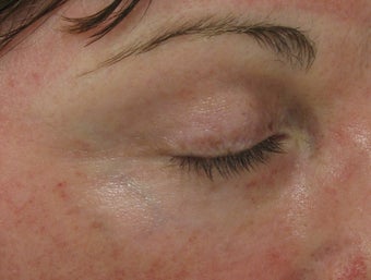 Fraxel re:pair (repair) CO2 laser resurfacing blepharoplasty
