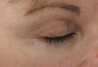 Fraxel re:pair (repair) CO2 laser resurfacing blepharoplasty