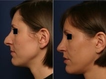 Rhinoplasty revision