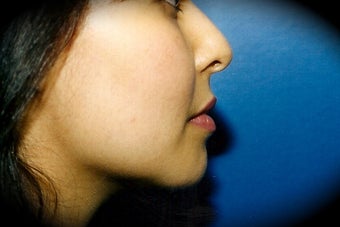 Chin Augmentation