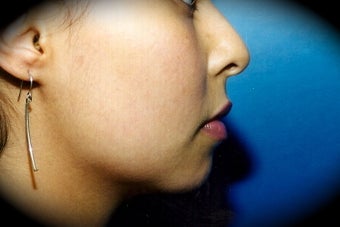 Chin Augmentation