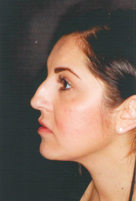 Septorhinoplasty