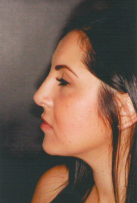 Septorhinoplasty