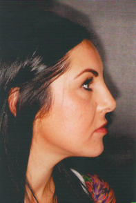 Septorhinoplasty