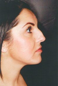 Septorhinoplasty