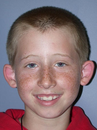 Otoplasty, Ear Surgery