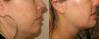 Neck Liposuction and Chin Implant
