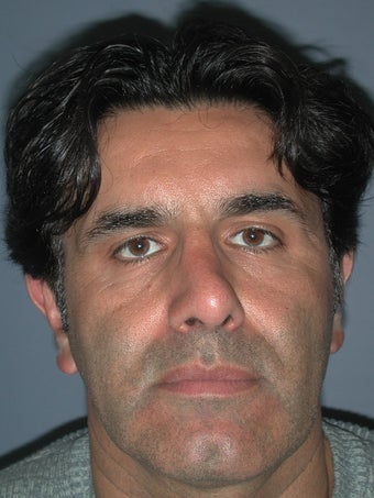 Otoplasty, Ear Surgery