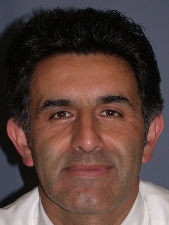 Otoplasty, Ear Surgery