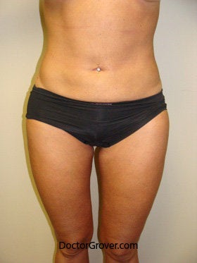 Liposuction