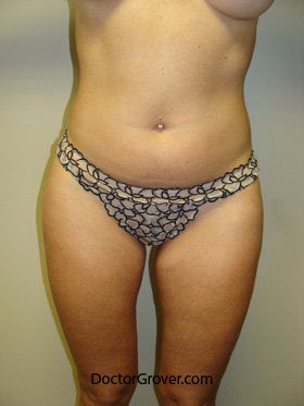 Liposuction