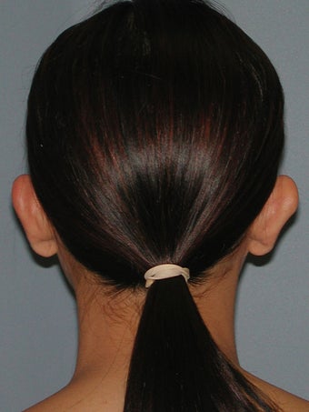 Otoplasty, Ear Surgery