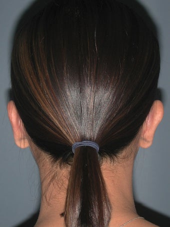 Otoplasty, Ear Surgery