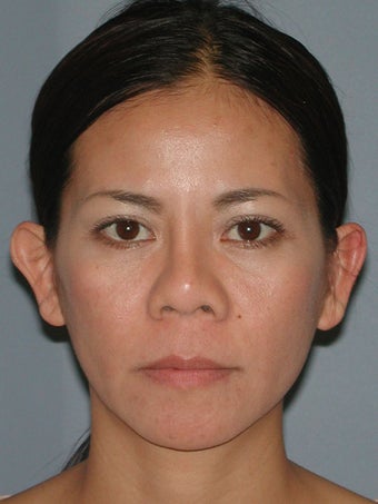 Otoplasty, Ear Surgery