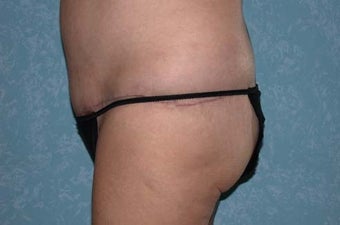 Circumferential Body Lift