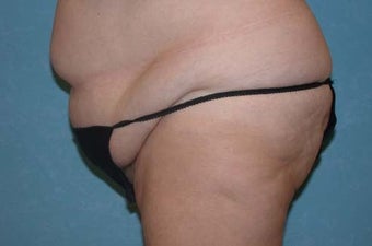 Circumferential Body Lift