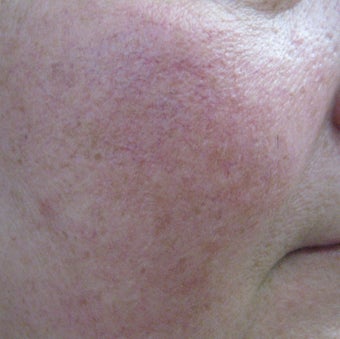 64 year old male with facial veins / telangiectasia