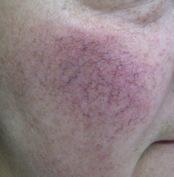 64 year old male with facial veins / telangiectasia