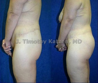 before and after photo silicone buttock implant and lift after RNY gastric bypass after massive weight loss after 360 bodylift 