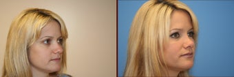 Repair of crooked nose