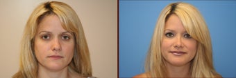 Repair of crooked nose