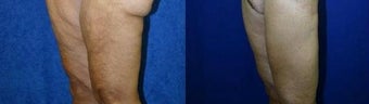 Thigh Lift after massive weight loss