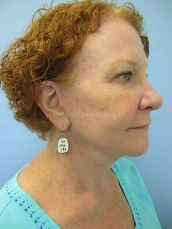 Face skin rejuvenation, woman, spot removal