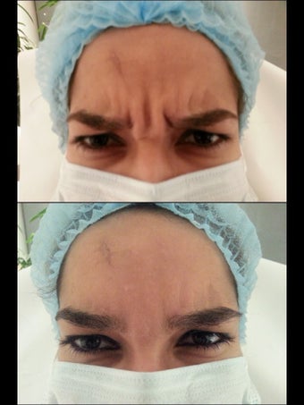 25 yrs old female wit forehead wrinkles