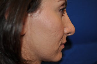 Female Patient Received Rhinoplasty to Remove Bump on Nasal Bridge