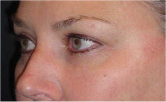 Restylane
