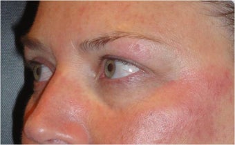 Restylane