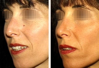 42 year-old female with a nose she feels is “too big” in proportion to the rest of her facial features. 