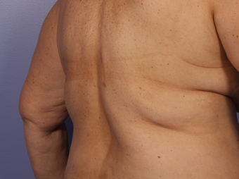 CoolSculpting to Bra Rolls/Back Fat