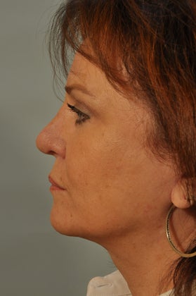 Revision Rhinoplasty