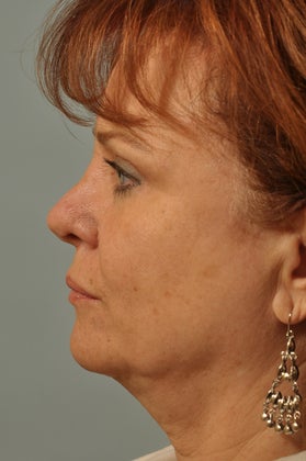 Revision Rhinoplasty