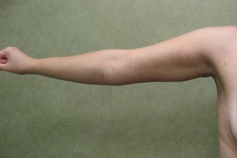 Arm Lift