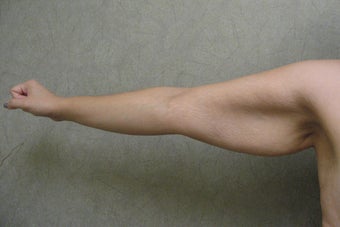 Arm Lift
