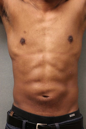 42 Year Male Treated to Increase Ab Definition 