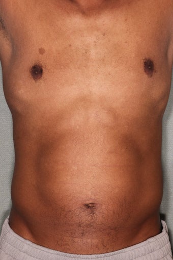42 Year Male Treated to Increase Ab Definition 
