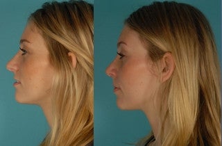 Revision Rhinoplasty