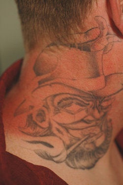 Neck Tattoo Removal -Laser Treatment