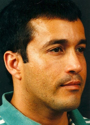 Chin Implant