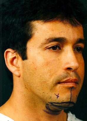 Chin Implant